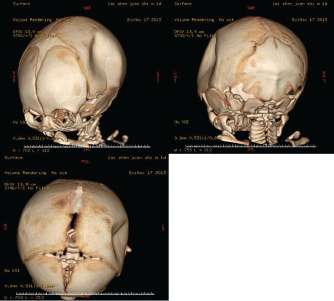 depressed-skull-fracture-surgery-in-a-1-year-old--dr-mustafa-chandshah-neurosurgeon-hubli-north-karnataka-thumbnail