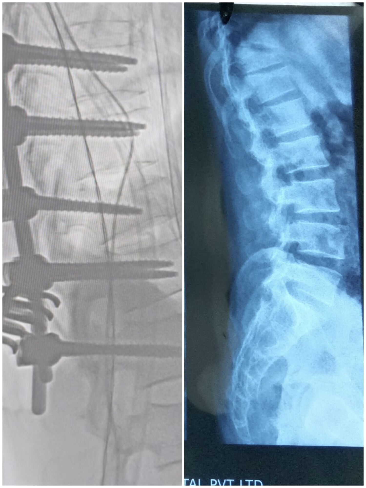 from-injury-to-recovery-how-spine-surgery-changed-this-young-mans-life--dr-mustafa-chandshah--neurosurgeon-hubli-karnataka-image