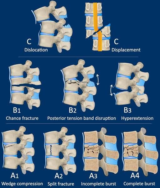 from-injury-to-recovery-how-spine-surgery-changed-this-young-mans-life--dr-mustafa-chandshah--neurosurgeon-hubli-karnataka-thumbnail