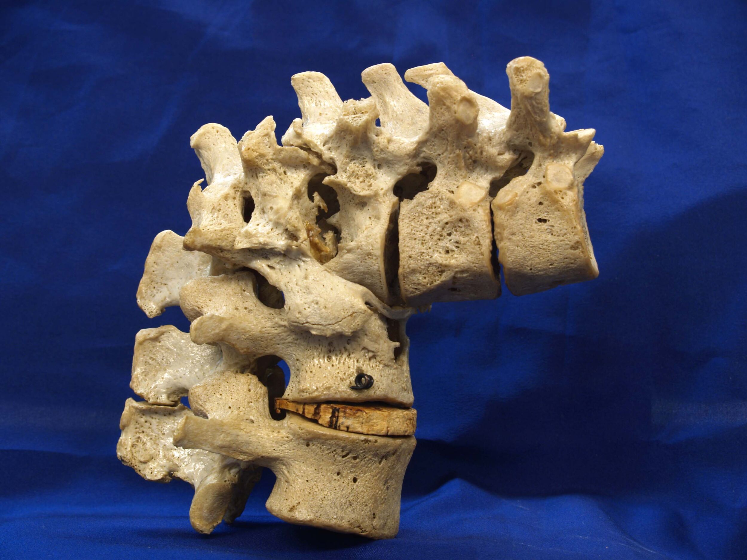 where-theres-life-theres-hope-consultant-neurosurgeon-dr-mustafa-chandshah-in-hubli-karnataka--a-life-changing--surgery-of-tb-spine-thumbnail