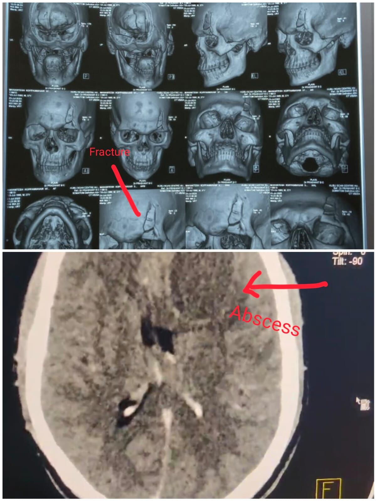 prevention-is-better-than-cure--how-timely-brain-surgery-saved-a-life----------by-dr-mustafa-chandshah--leading-neurosurgeon-in-hubli-thumbnail