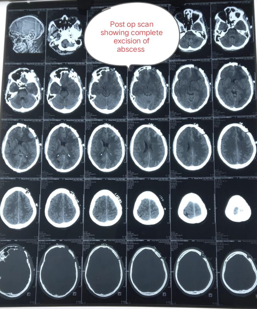 prevention-is-better-than-cure--how-timely-brain-surgery-saved-a-life----------by-dr-mustafa-chandshah--leading-neurosurgeon-in-hubli-image