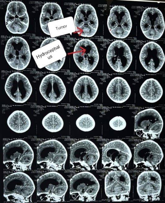 a-stitch-in-time-saves-nine--life-saving-brain-surgery-in-a-child--dr-mustafa-chandshah--neurosurgeon-hubballi-hubli-karnataka-----------------thumbnail