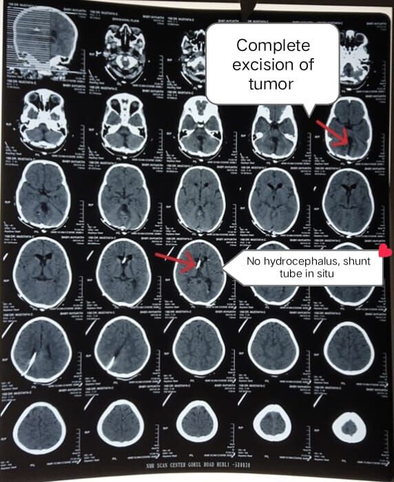 a-stitch-in-time-saves-nine--life-saving-brain-surgery-in-a-child--dr-mustafa-chandshah--neurosurgeon-hubballi-hubli-karnataka-----------------image
