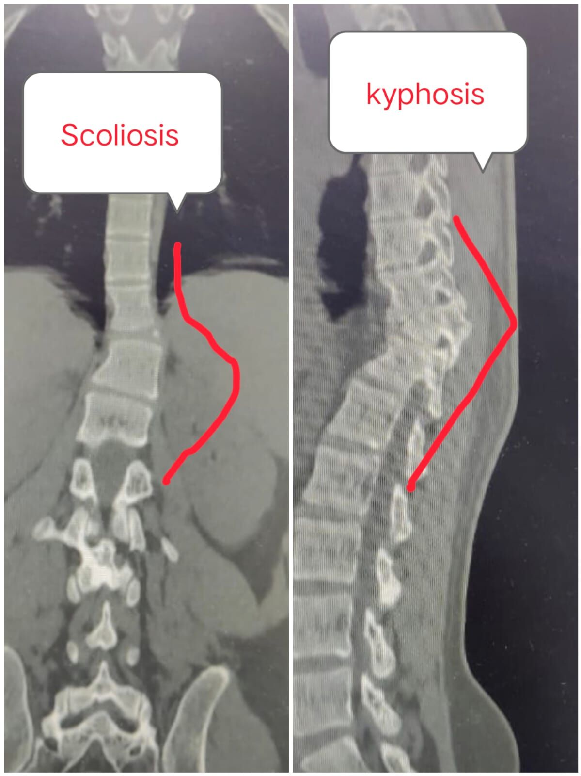 straightening-the-crooked-path--timely-spine-surgery-restores-mobility---------------by-dr-mustafa-chandshah--leading-neurosurgeon-hubli-karnataka-thumbnail