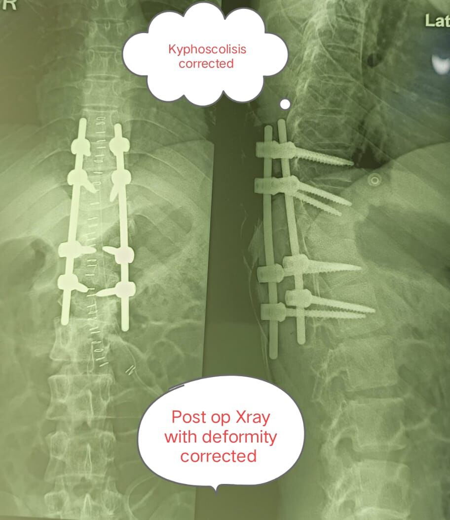 straightening-the-crooked-path--timely-spine-surgery-restores-mobility---------------by-dr-mustafa-chandshah--leading-neurosurgeon-hubli-karnataka-image