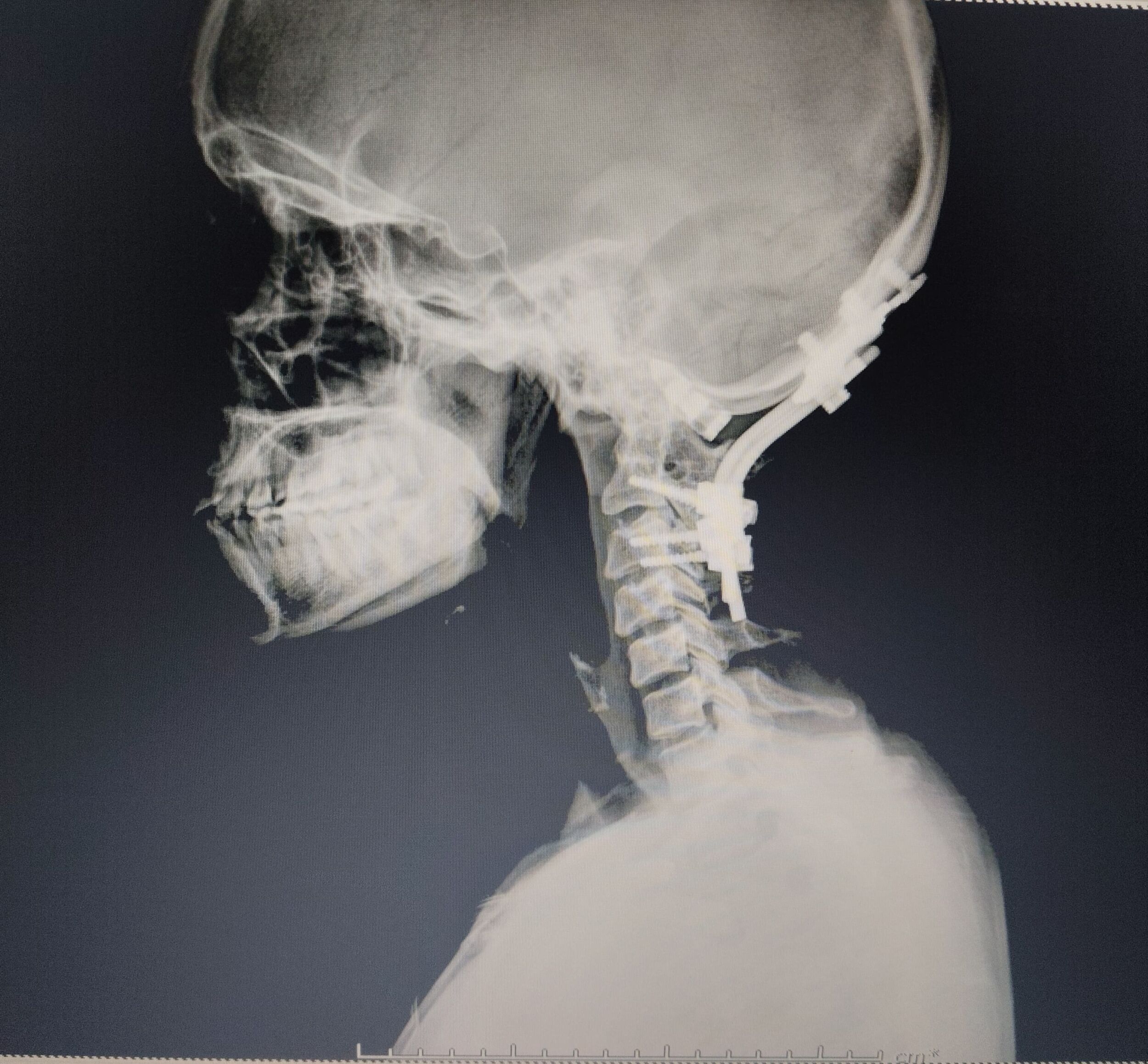 when-the-neck-holds-the-key-to-life--a-story-of-courage-and-healing-by-dr-mustafa-chandshah--leading-neurosurgeon-hubli-karnataka-thumbnail