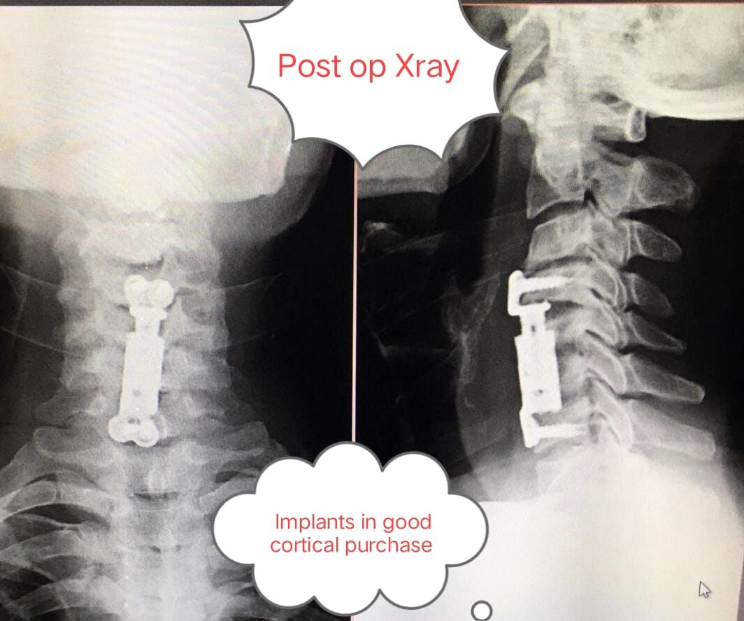 bending-not-breaking--how-timely-surgery-restored-a-farmers-life-in-gadag------------by-dr-mustafa-chandshah--leading-neurosurgeon-hubli-karnataka-image