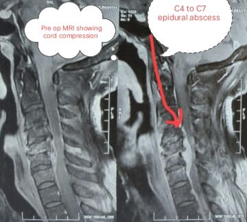 bending-not-breaking--how-timely-surgery-restored-a-farmers-life-in-gadag------------by-dr-mustafa-chandshah--leading-neurosurgeon-hubli-karnataka-thumbnail