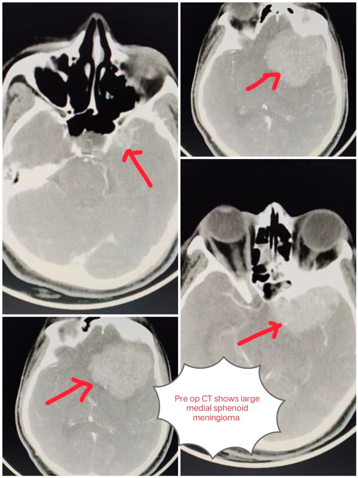 a-battle-near-the-optic-nerve--winning-against-a-giant-brain-tumor-----------dr-mustafa-chandshah--consulatant-neurosurgeon-hubli-karnataka-thumbnail