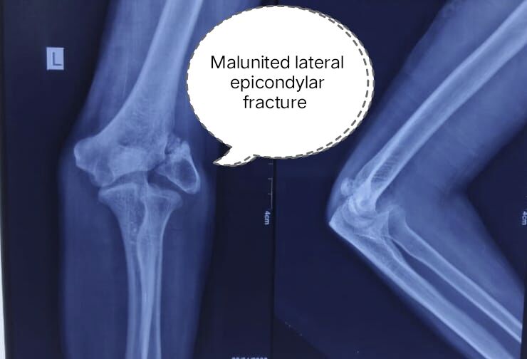 old-wounds-new-troubles--but-timely-surgery-heals--dr-mustafa-chandshah--leading-neurosurgeon-in-hubli-karnataka-image