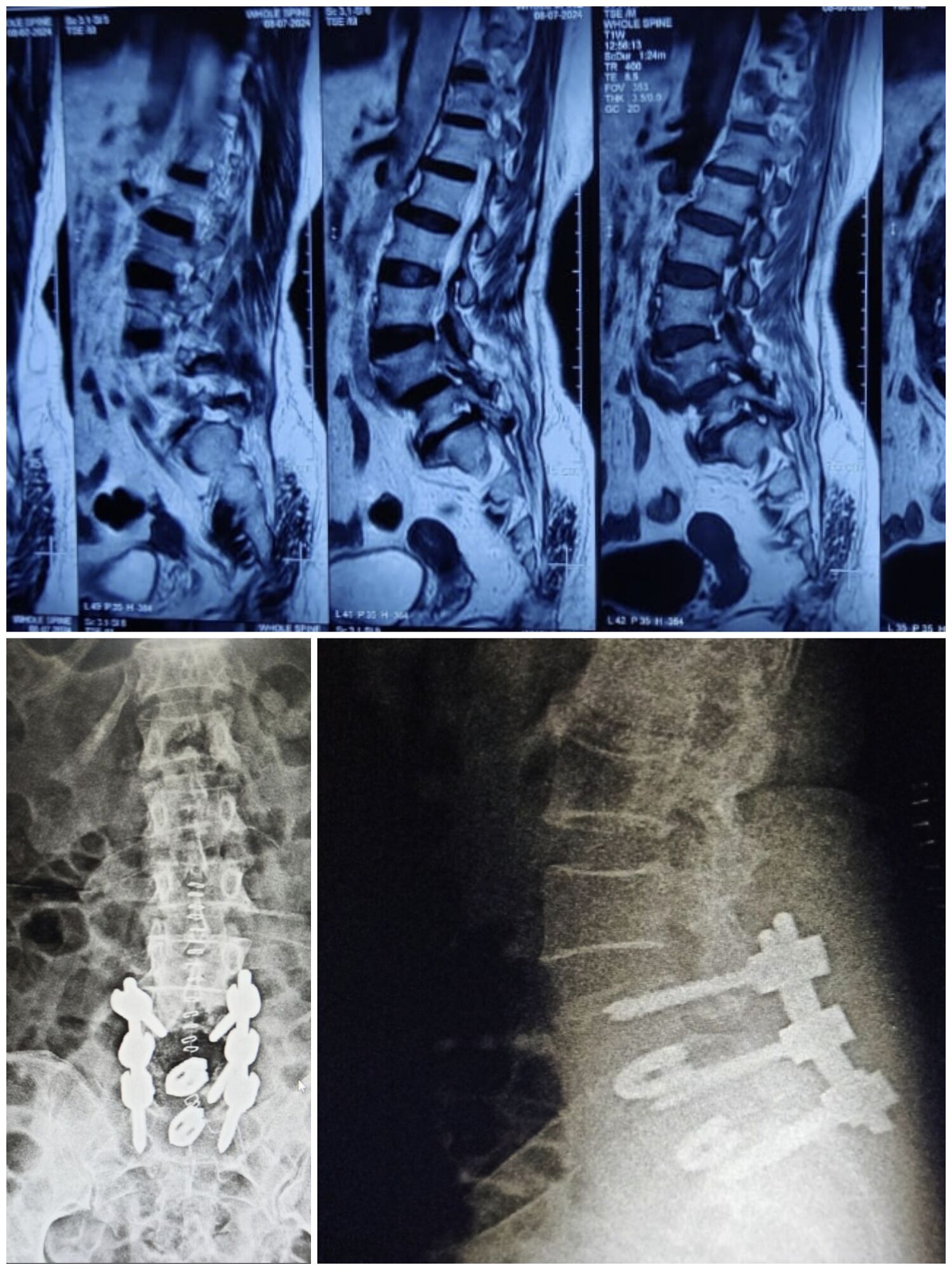 tlif-surgery-a-new-ray-of-hope-for-spine-pain-tlif-------dr-mustafa-chandshah--neurosurgeon-hubli-karnataka-image